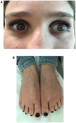 Stormorken Syndrome Caused by a p.R304W STIM1 Mutation: The First Italian Patient and a Review of the Literature